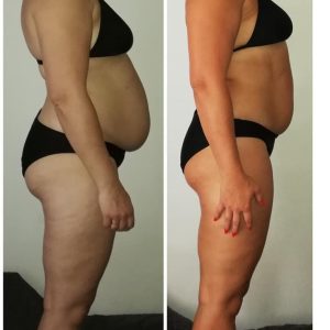 metamorfozy przed i po aplikacja miazga 00187