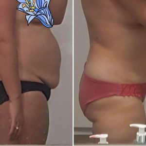 metamorfozy przed i po aplikacja miazga 00195