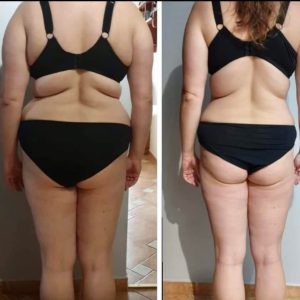 metamorfozy przed i po aplikacja miazga 00200