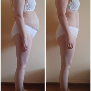 metamorfozy przed i po aplikacja miazga 00202