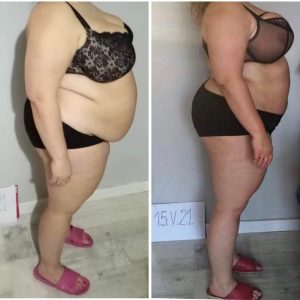 metamorfozy przed i po aplikacja miazga 00203