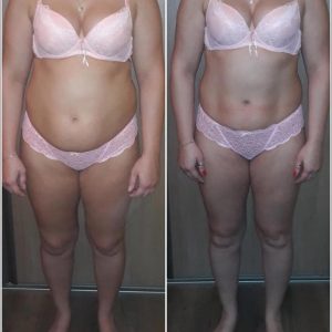 metamorfozy przed i po aplikacja miazga 00205