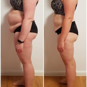 metamorfozy przed i po aplikacja miazga 00209