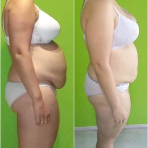 metamorfozy przed i po aplikacja miazga 00210