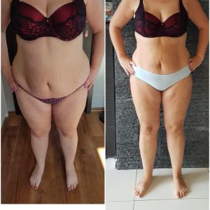 metamorfozy przed i po aplikacja miazga 00211