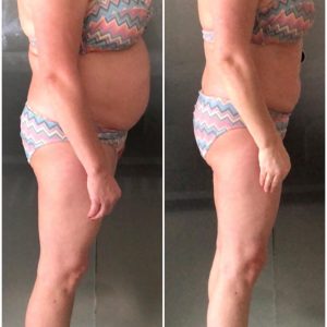 metamorfozy przed i po aplikacja miazga 00212