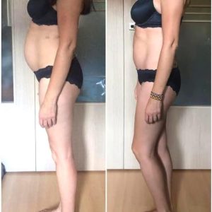 metamorfozy przed i po aplikacja miazga 00216