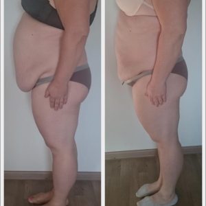 metamorfozy przed i po aplikacja miazga 00228