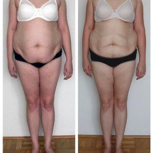 metamorfozy przed i po aplikacja miazga 00231