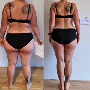 metamorfozy przed i po aplikacja miazga 00235