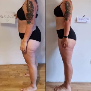 metamorfozy przed i po aplikacja miazga 00236