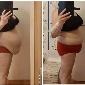 metamorfozy przed i po aplikacja miazga 00238