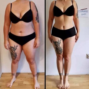 metamorfozy przed i po aplikacja miazga 00242