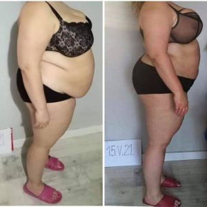 metamorfozy przed i po aplikacja miazga 00250