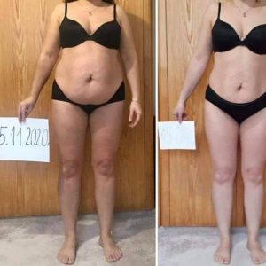 metamorfozy przed i po aplikacja miazga 00257