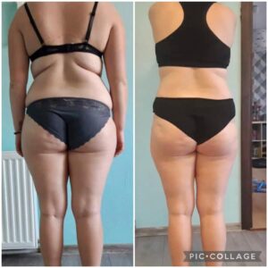 metamorfozy przed i po aplikacja miazga 00259