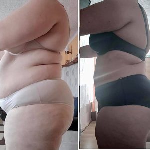 metamorfozy przed i po aplikacja miazga 00273