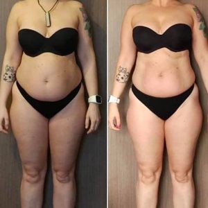 metamorfozy przed i po aplikacja miazga 00276