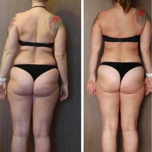 metamorfozy przed i po aplikacja miazga 00279