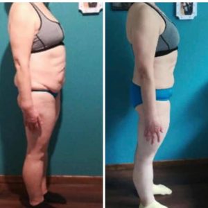 metamorfozy przed i po aplikacja miazga 00280