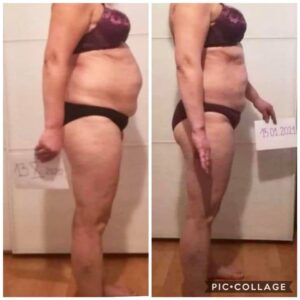 metamorfozy przed i po aplikacja miazga 00283