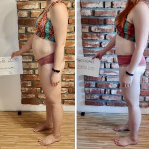 metamorfozy przed i po aplikacja miazga 00292