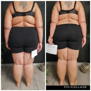 metamorfozy przed i po aplikacja miazga 00296