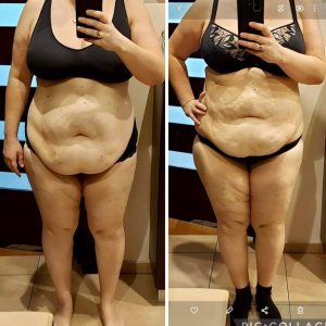 metamorfozy przed i po aplikacja miazga 00307