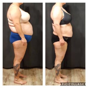 metamorfozy przed i po aplikacja miazga 00311